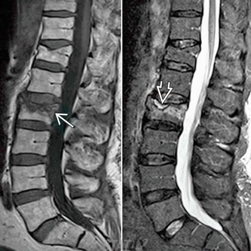 colonnavertebralepro-terapia-cifovertebroplastica-linee-guida-generali-1